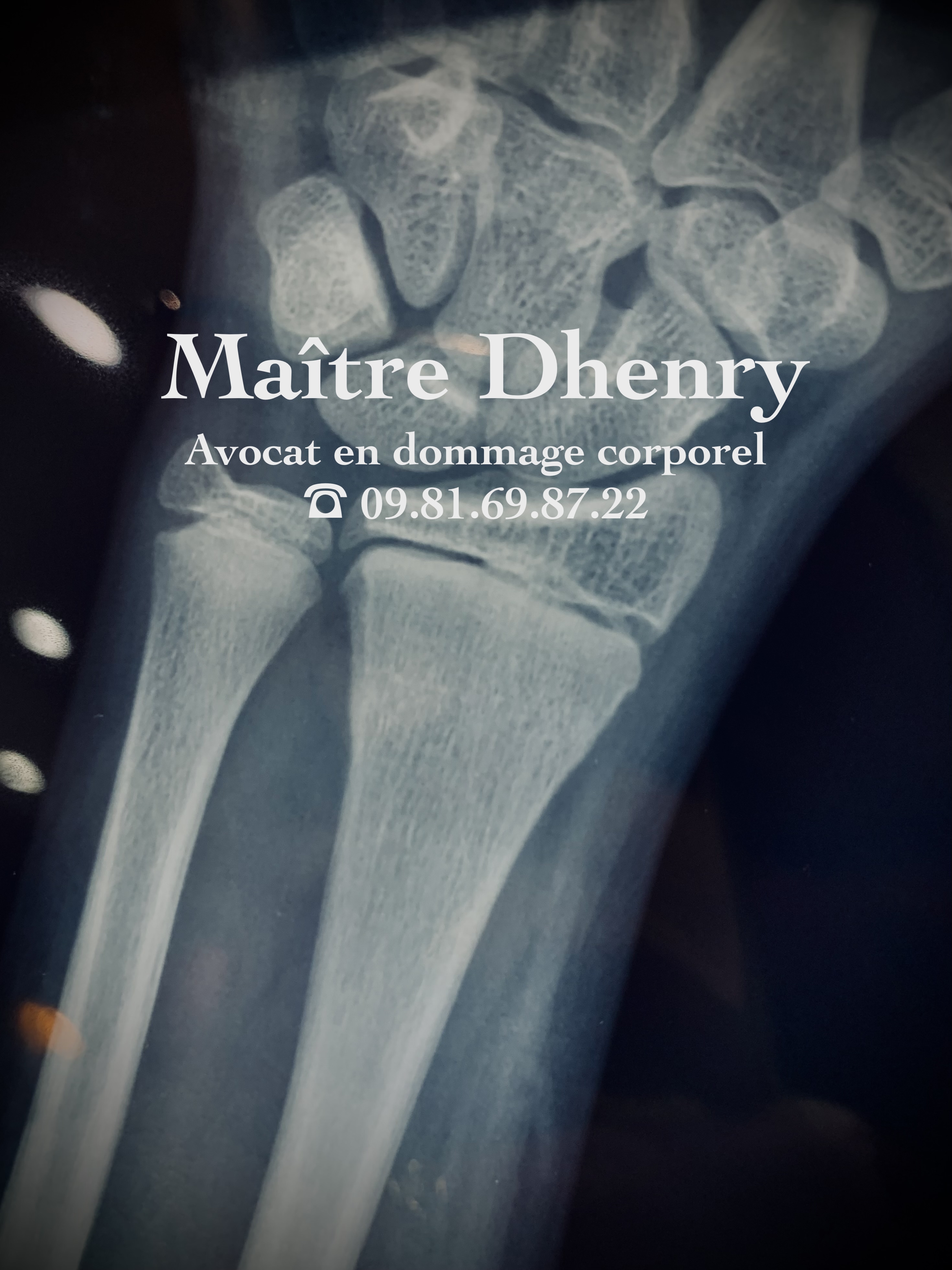 Dommage corporel : qui règle les frais de rééducation et d’ostéopathie ?